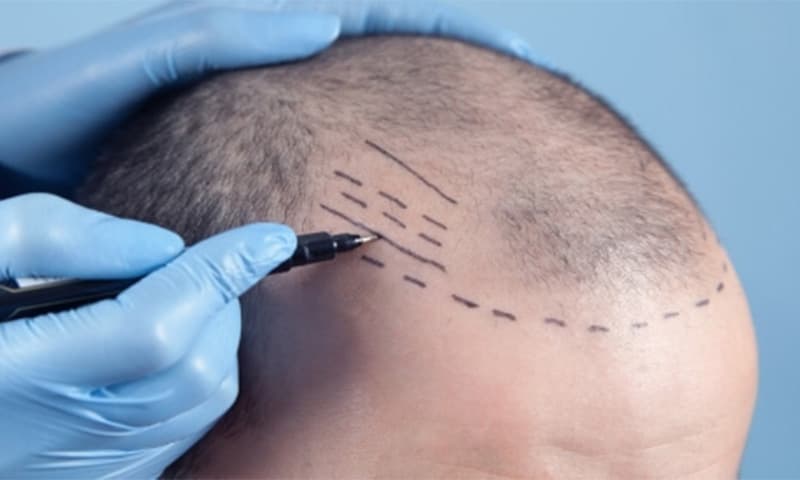 زراعة الشعر: الطرق والأساليب والتفاصيل الكاملة