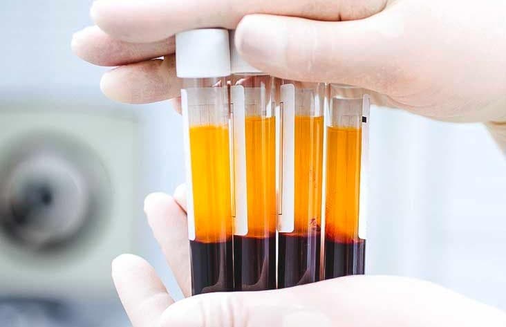 العلاج بالبلازما الغنية بالصفائح الدموية (PRP): تجديد طبيعي للبشرة والشعر