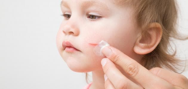علاج خدوش الوجه بالأظافر للأطفال